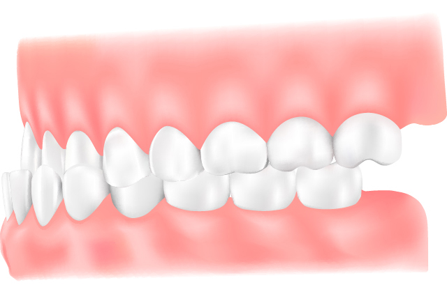 下顎前突（かがくぜんとつ）
                    